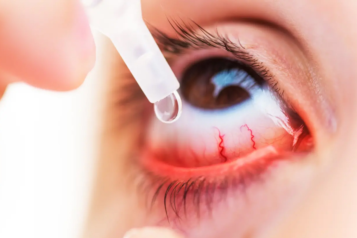 Pathologies Centre Ophtalmologique Ruy Montceau